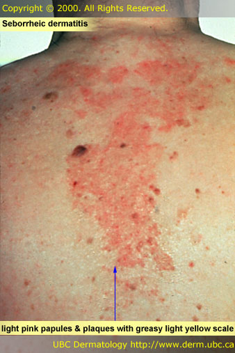 Seborrheic dermatitis