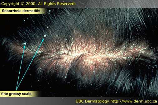 Seborrheic dermatitis