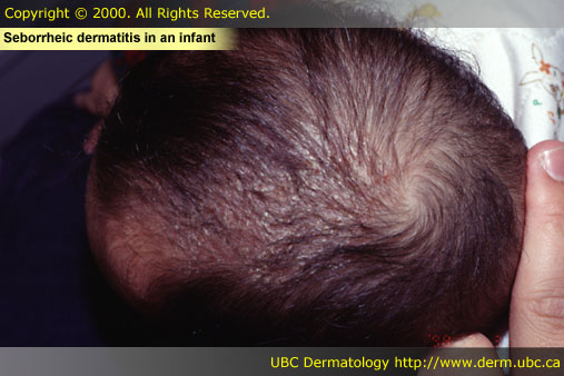 Seborrheic dermatitis