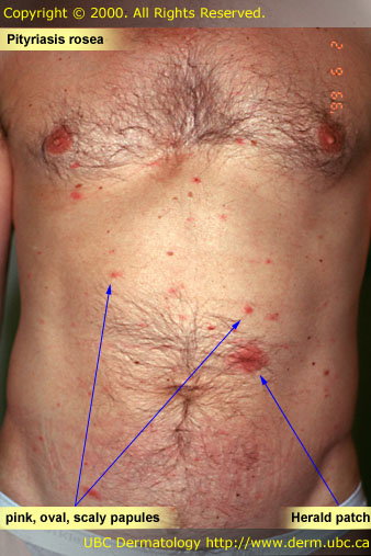 Pityriasis rosea