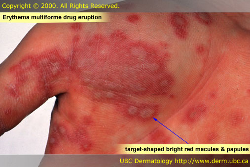 Drug eruptions