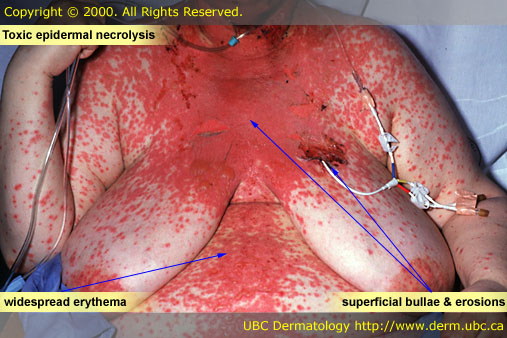 Drug eruptions