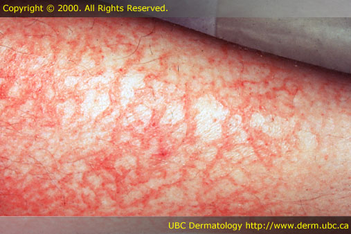 Atopic dermatitis