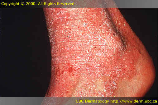 Atopic dermatitis