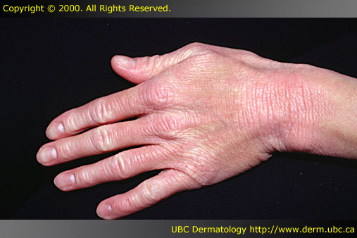 Adult atopic dermatitis