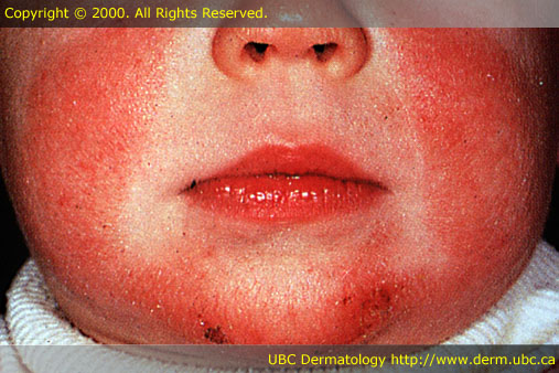 Infant atopic dermatitis