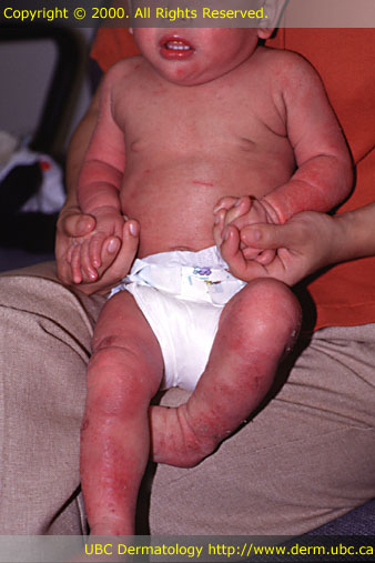 Infant atopic dermatitis