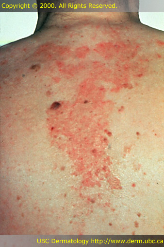 Seborrheic dermatitis