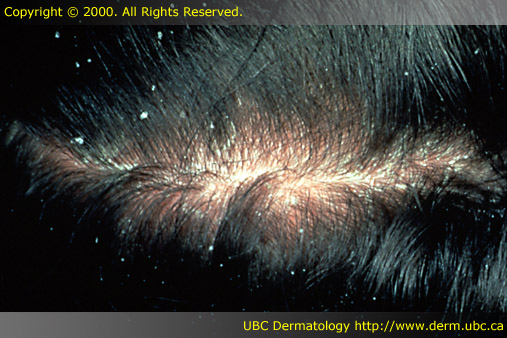 Seborrheic dermatitis