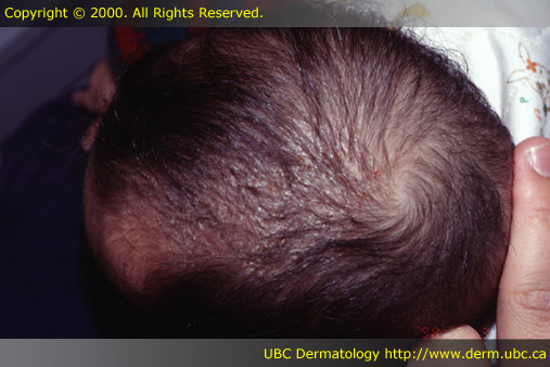 Seborrheic dermatitis