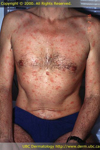 Pityriasis rosea