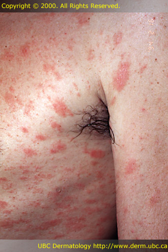 Recurrence of Pityriasis Rosea - Dermatology - MedHelp