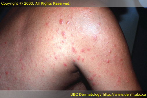 Pityriasis rosea