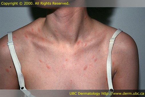 Pityriasis rosea