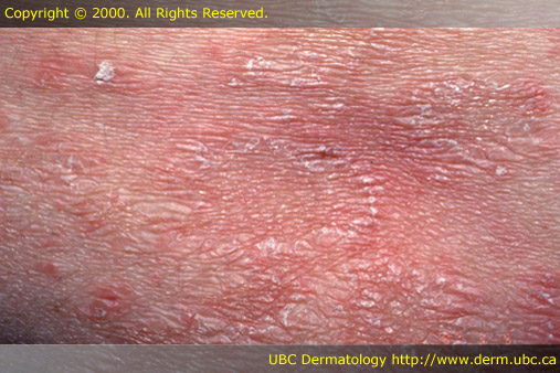 Pityriasis rosea