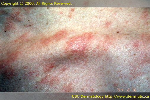 Pityriasis rosea