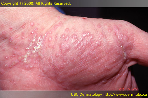 Lichen planus