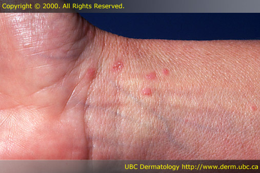 Lichen planus