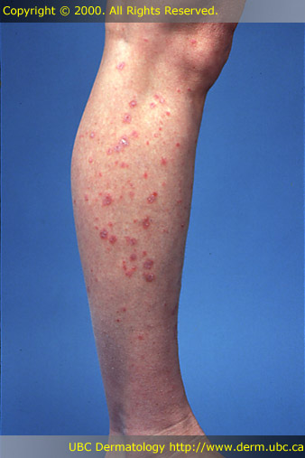 Lichen planus