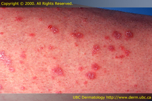 Lichen planus