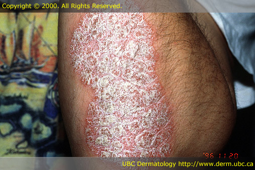 Psoriasis