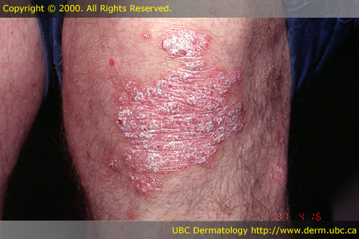 Psoriasis