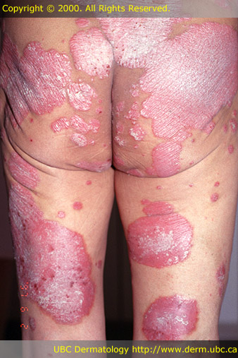 Psoriasis