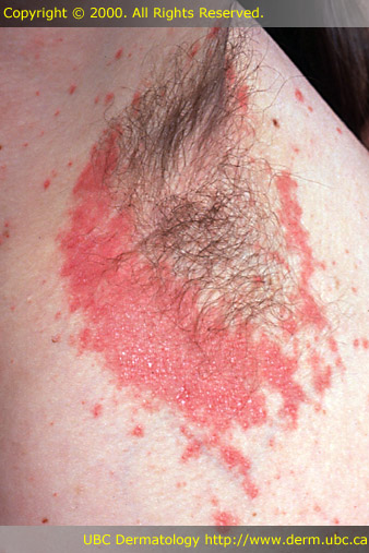 gluteal cleft psoriasis treatment