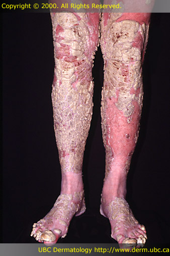 Psoriasis