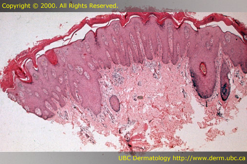 Psoriasis