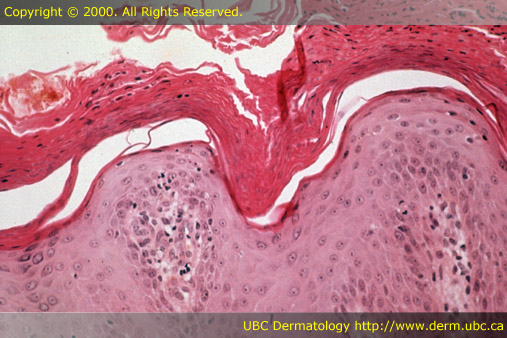 Psoriasis