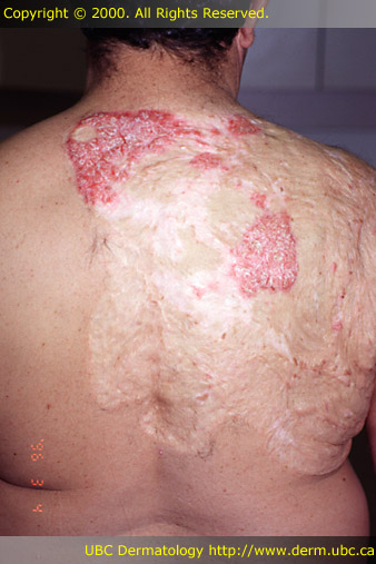 Psoriasis