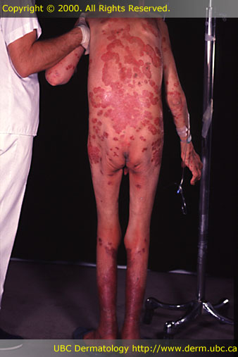 Psoriasis