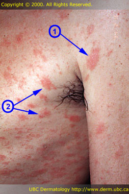 guttate psoriasis herald patch