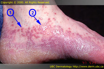 Lichen planus