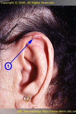 Chondrodermatitis nodularis helicis