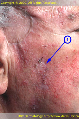 Actinic keratosis