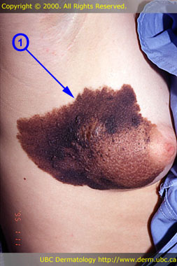 Congenital melanocytic nevus