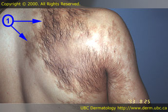 Becker's nevus