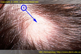 Alopecia areata