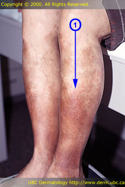 Leukocytoclastic vasculitis