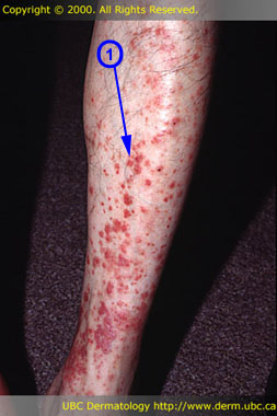 Pigmented purpuric dermatosis