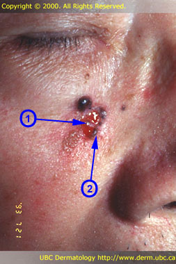 Pigmented basal cell carcinoma