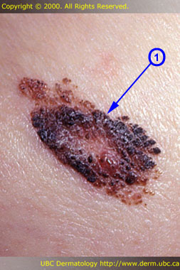 Seborrheic keratosis