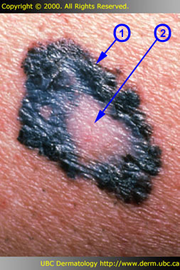 Melanoma