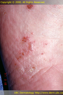 Tinea pedis