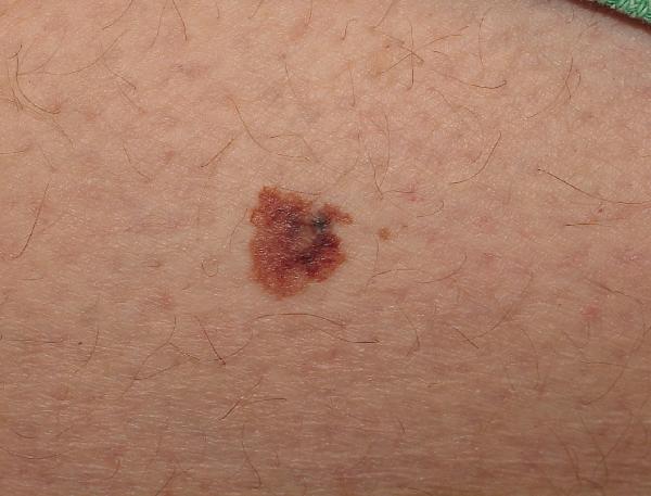 Melanoma Image 10B - Medium