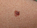 Melanoma Image 10B - Small
