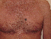 Melanoma Image 11A - Small