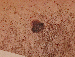 Melanoma Image 13 - Small